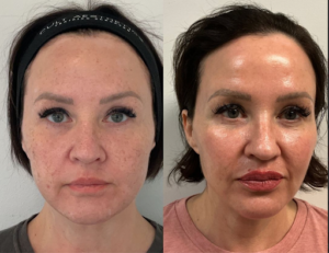 Moxi treatment before and after